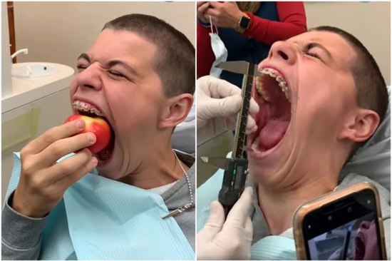 شاب أمريكي يدخل موسوعة غينيس بفضل فمه الكبير