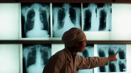 مذكرة توقيف بحق أميركية رفضت علاجها من مرض السل