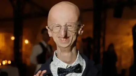 إيطاليا.. وفاة المصاب بالشيخوخة المبكرة الأطول عمرا