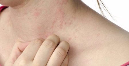 أعراض حساسية الجلد في الصّيف.. أسبابها وطرق علاجها