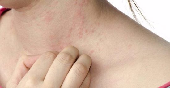 أعراض حساسية الجلد في الصّيف.. أسبابها وطرق علاجها