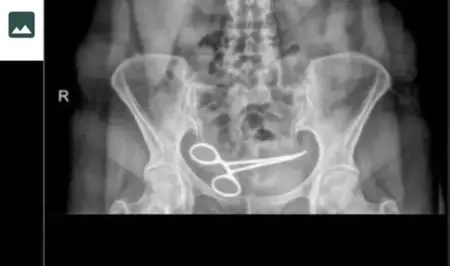 سيدة تركية تكتشف وجود مقص في بطنها بعد 8 أشهر من إجراء عملية جراحية