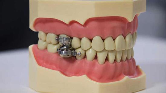 لمحاربة السمنة .. ابتكار جهاز "قفل الأسنان"