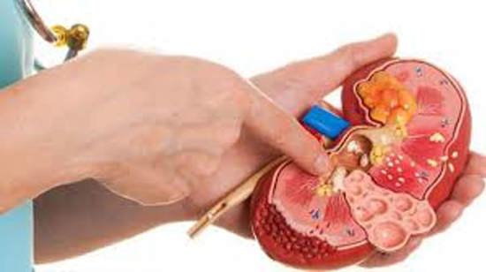 عملية نادرة في تركيا.. استخراج 51 حصاة من مجرى البول