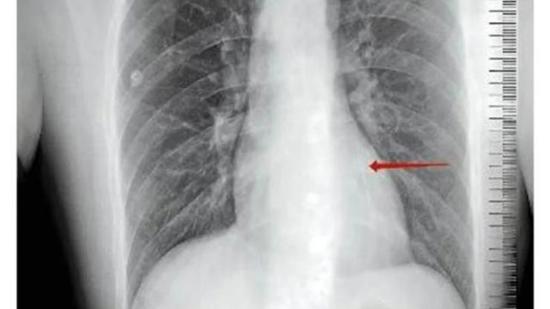 دخل المستشفى لسبب عادي.. فاكتشف الأطباء شيئاً في قلبه