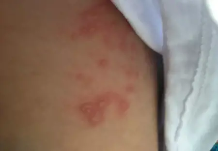 خبيرة: التهابات الجلد القيحية قد تصيب حتى شديدي النظافة.. والسبب غير متوقّع