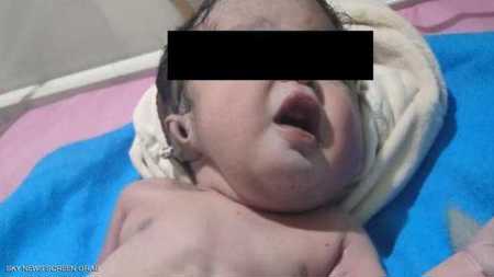 أغرب من الخيال .. ولادة "ووفاة" طفل بحالة نادرة في مصر