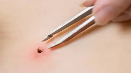 وفاة شاب بسبب فيروس "كريم-كونغو" في سيواس بعد لدغة قرادة