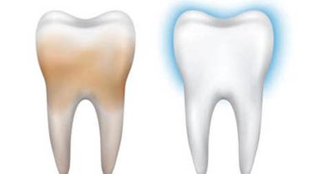 سبعة علاجات بسيطة لمكافحة البقع الصفراء على الأسنان