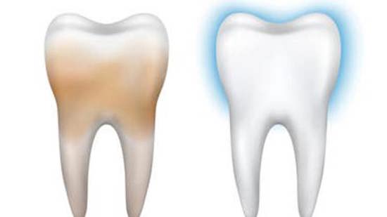 سبعة علاجات بسيطة لمكافحة البقع الصفراء على الأسنان