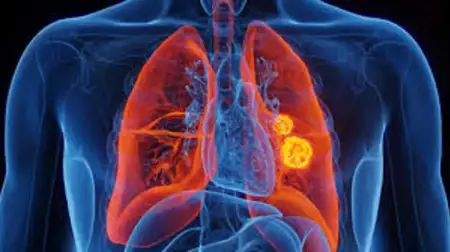 تركيا تطلق برنامجًا مبتكرًا لتحسين تنفس مرضى الرئة