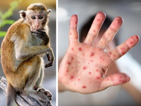 وزارة الصحة الإماراتية تعلن اكتشاف ثلاث حالات جديدة لجدري القرود