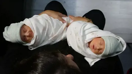 حالة نادرة «واحدة بالمليون» في طرابزون: أمّ بـرحمَين تُنجب من كلٍّ منهما في وقت واحد