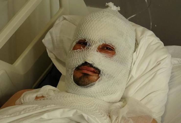 أُصيب بحروقٍ بالغة وهو يحاول إنقاذ والدته وأقاربه من حريقٍ كهربائيّ في هطاي