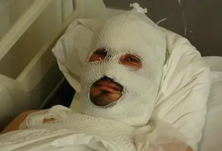 أُصيب بحروقٍ بالغة وهو يحاول إنقاذ والدته وأقاربه من حريقٍ كهربائيّ في هطاي