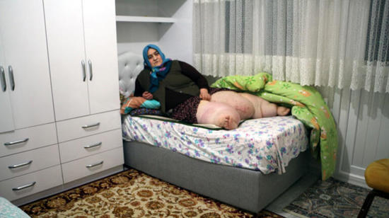 سيدة تناشد لعلاجها من داء "الفيل" في توكات شمالي تركيا