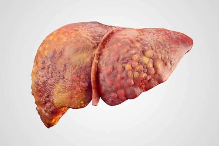 دراسة: أعراض غير شائعة تنذر بالإصابة بالتليف الكبدي